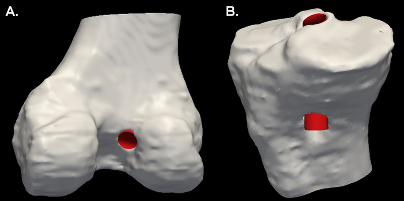 3D image showing the exit points of the tunnel drilled for the ligament graft.