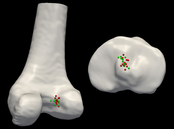 Dots on the 3D images show the wide variation in surgeons' tendon attachment points.
