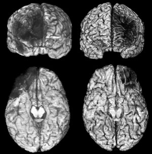 Damage to the vmPFC shows up as black areas in two patients' brain scans. In both patients, the damage occurred prior to age 18. Images courtesy of the UI Department of Neurology.